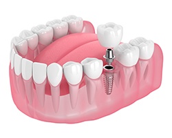 Illustration of single dental implant