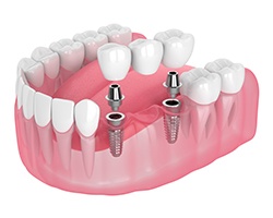 Illustration of implant bridge